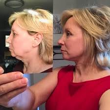 We are so excited to have our very first facial plastic and reconstructive  surgery fellow joining us this year! Dr. Rachel Fee just completed her  residency training with us and will now