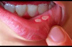 Check spelling or type a new query. Penyebab Sariawan Di Tenggorokan Dan Cara Mengobatinya Himedik Com