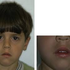 PDF) Palatal expansion in a patient with solitary median maxillary central  incisor syndrome