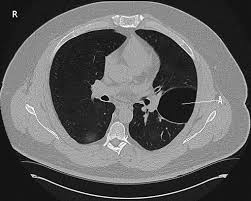 Catamenial pneumothorax is a rare type of pneumothorax and is characterized by the recurrent accumulation of air in the thoracic space related to menstruation. Figure Ct Bulla Ct Scan Pneumothorax Contributed By Steve Bhimji Ms Md Phd Statpearls Ncbi Bookshelf