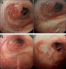 Tumor carcinoide retroperitoneal en nuestra serie, esto es algo muy infrecuente y sólo aparece descrito. A Tumor Carcinoide En Bronquio Intermediario B Tres Meses Download Scientific Diagram