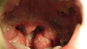 Some people may experience a burning sensation or pain in the throat when swallowing. Sore Throat Treatment Causes Diagnosis Symptoms More