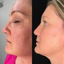 Frontier Dermatology Aesthetics, 21727 76th Ave W, Ste F, Edmonds, WA  98026, US