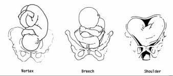 Image result for Shoulder Presentation