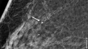 One should be very careful because breast cancer is life threatening Breast Cancer Discovered In Its Preliminary Stages In Mammography Screening Is Usually Aggressive Medica World Forum For Medicine