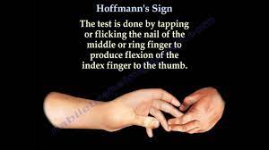 Hoffmann reflex information including symptoms, causes, diseases, symptoms, treatments, and these medical condition or symptom topics may be relevant to medical information for hoffmann. Hoffmann S Sign Everything You Need To Know Dr Nabil Ebraheim Youtube