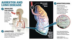 Asbestos produces the following lung disorders: Asbestos Poisoning