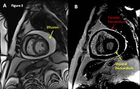 New Diagnostic Criteria For Acute Pericarditis A Cardiac Mri Perspective American College Of Cardiology