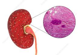 Image result for Acute Pyelonephritis