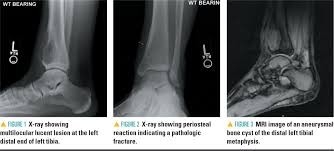 Broke my lateral malleolus 4 weeks ago, no surgery (thankfully) and i got placed in a cam walking boot. Teenager With Ankle Pain And Swelling Contemporary Pediatrics