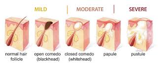 Stages And Severity Of Acne Diagram Teenage Acne Acne