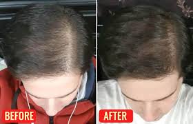 Calcipotriol is a synthetic form of vitamin d. Emu Oil For Hair Growth How To Use Benefits Reviews