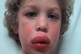 How To Help A Child Having An Allergic Reaction Dx2 Training Solutions