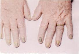 Pulmonary Manifestations Of The Yellow Nail Syndrome Chest