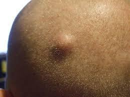 A rash or cyst, bump or any sort of i. Ingrown Hair Cyst Cure