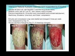 1 Novel Approach To Chronic Wounds Youtube Wounds Chronic Dermatillomania