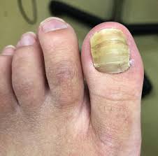 Image result for Koilonychia feet