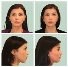 Cheek Bone Surgery Nez