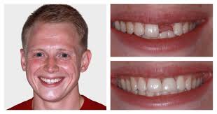 Dental Implants Testimonials