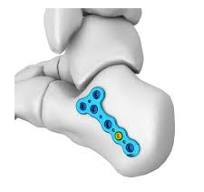 MT Posterior Tuberosity Calcaneal Locking Plate,Medical ...