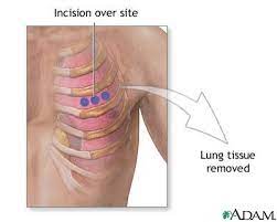 Open Lung Biopsy Lima Memorial Health System