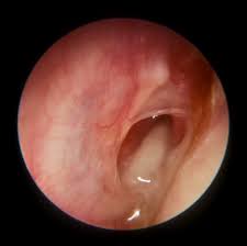 One of the two main types is acute otitis media (aom), an infection of rapid onset that usually presents with ear pain. Acute Otitis Media