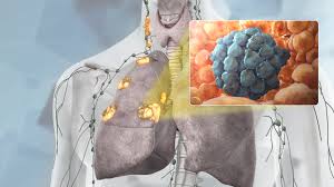 These survival rates for the most advanced lung cancer stages are estimated using a slightly different benchmark. Stage 3 Lung Cancer All That You Need To Know Scientific Animations