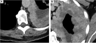 malignant pleural mesothelioma:comparison of ct and mr imaging for staging. Delayed Phase Enhancement For Evaluation Of Malignant Pleural Mesothelioma On Computed Tomography A Prospective Cohort Study Clinical Lung Cancer