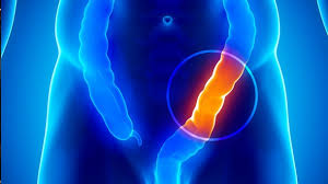 Eine verstopfung (obstipation) ist eine zu geringe stuhlfrequenz (weniger als 3 mal die woche), ein fehlender stuhldrang. Verstopfung Hilfreiche Hausmittel Bei Obstipation