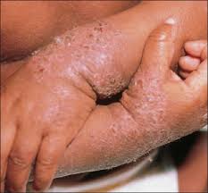 Itching is a symptoms that may be associated with other signs and symptoms depending on what caused them. Pruritus In Children What S Itching Consultant360