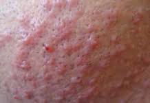 At first i didn't realize it was an ingrown hair. Ingrown Hair On Scrotum Testicle Sack Symptoms Pictures Causes Get Rid Removal Treatment