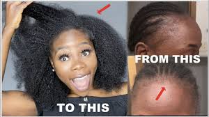 So, to regrow your hairline, you will need to massively increase the blood flow to these receded parts of your scalp. How To Regrow Your Edges Hairline Back Fast 2 Products You Need Before And After Pics Part 2 Youtube