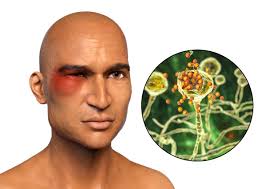 Comer frutos secos es bueno para la piel. Recuperados De Covid Con Mayor Riesgo A Hongo Negro Especialista