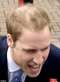 Prince William shows his thinning royal hair... and reveals he's wearing  BRACES