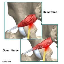 The piriformis muscle connects the lowermost vertebrae with the upper part of the leg after traveling the sciatic notch, the opening in the pelvic bone that allows the sciatic nerve to travel into the leg. Physical Therapy In Raleigh For Back Piriformis Syndrome