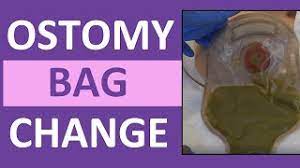 Ostomy Bag Pouch Change Ostomy Care Nursing Colostomy Ileostomy Bag Change Youtube