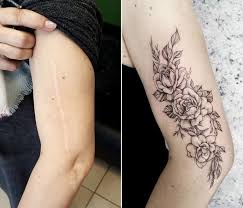 Alibaba.com offers 843 keloid laser removal products. Can You Get A Tattoo Over A Scar Authoritytattoo