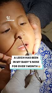 It's been growing in his nose for a month 😱