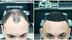 My question is will it work just as well if i shave down to a number 2 or 3? Fixed Balding Using Hair Fibers Youtube