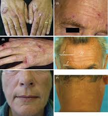 Full article: Clinical and forensic signs related to ethanol abuse: a  mechanistic approach