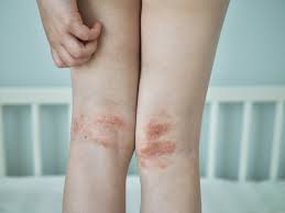 Image result for Atopic eczema atopic dermatitis