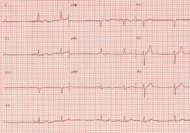 Arrhythmia News Treatment Articles Irregular Heartbeat