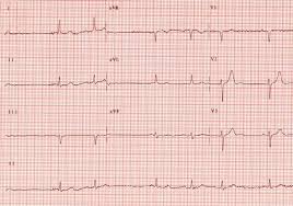 arrhythmia news treatment articles irregular heartbeat