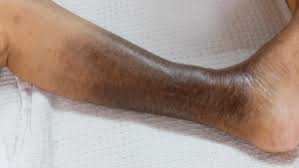 Image result for Pigment stains on the shin