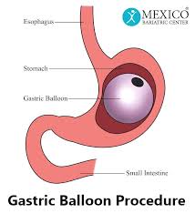 gastric balloon cost affordable self