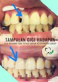Proses penambalan gigi depan patah | dokter gigi tri putra. Gigi Depan Reput Pecah Klinik Pergigian Asmah Facebook