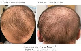 If you have any worries concerning any of the side effects or the process of taking the steroid injections, please discuss with your doctor or any verified medical personnel. Fda Approved Eczema Drug Dupixent Causes Hair Regrowth In Alopecia Sufferer