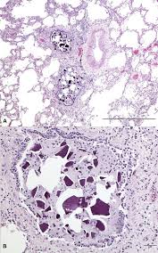 Image result for Kayexalate