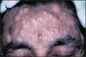 Image result for Gardner Sendromu