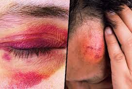 Breast cancer is most easily treated if spotted early. Pictures Of Bruises What The Black And Blue Is Telling You